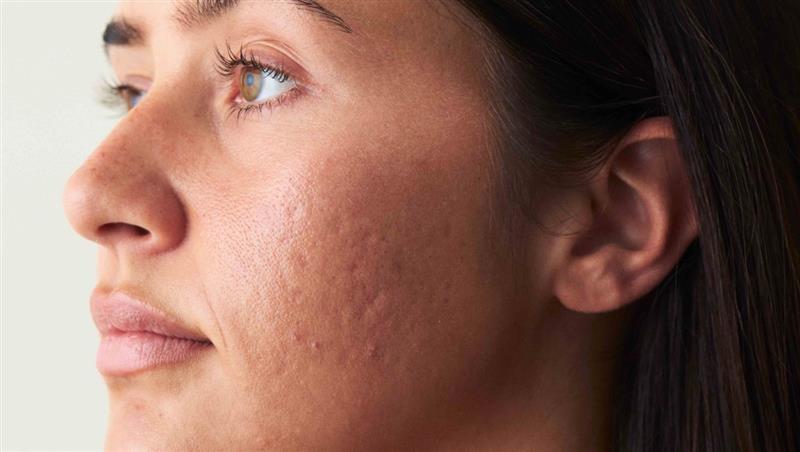 Gesicht mit Aknenarben auf der Wange