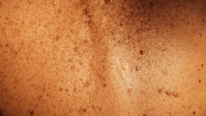 Hautarztbesuch: Was passiert beim Dermatologen?