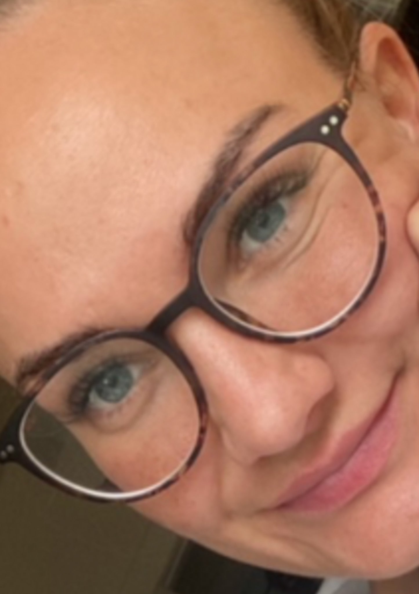 Nachher-Foto unreiner Haut