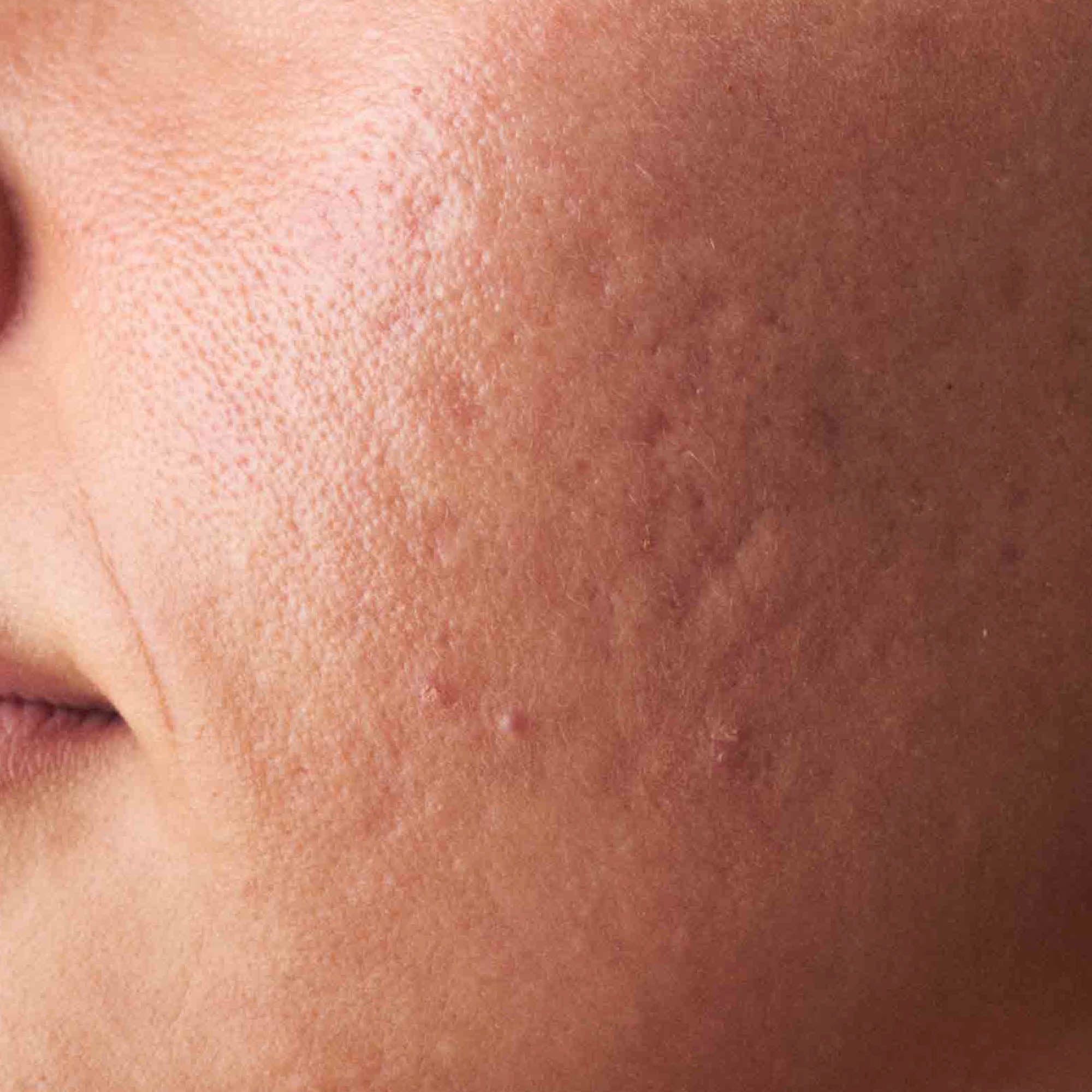 Nahaufnahme von unreiner Haut