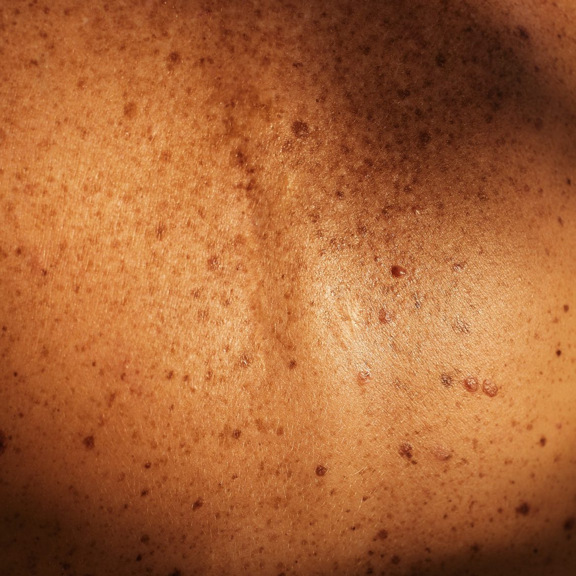 Rückenhaut mit Pigmentflecken