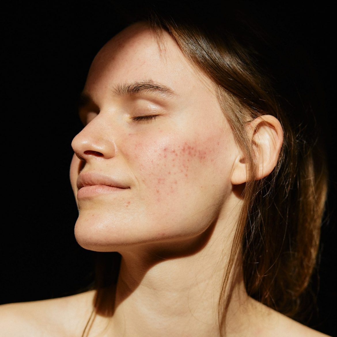 Frau mit Unreinheiten