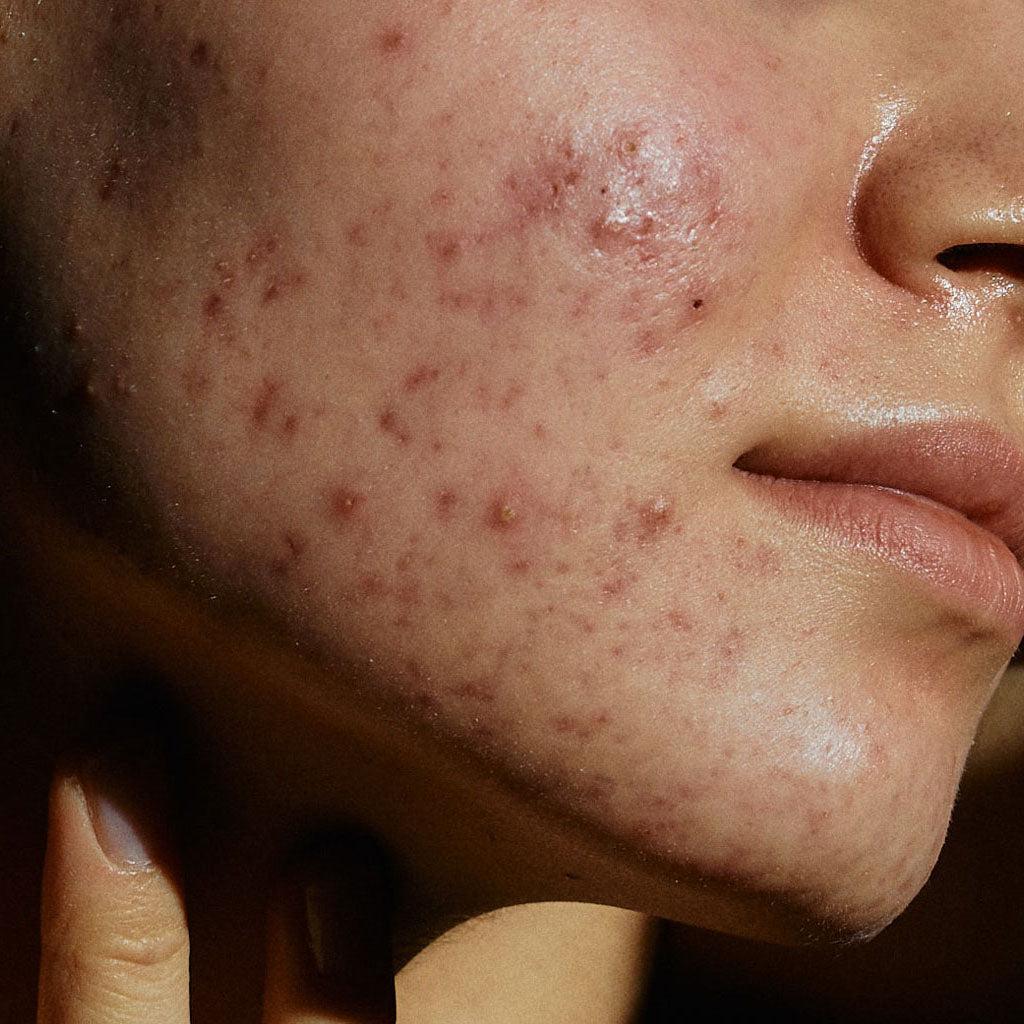 Gesichtshaut mit Unreinheiten
