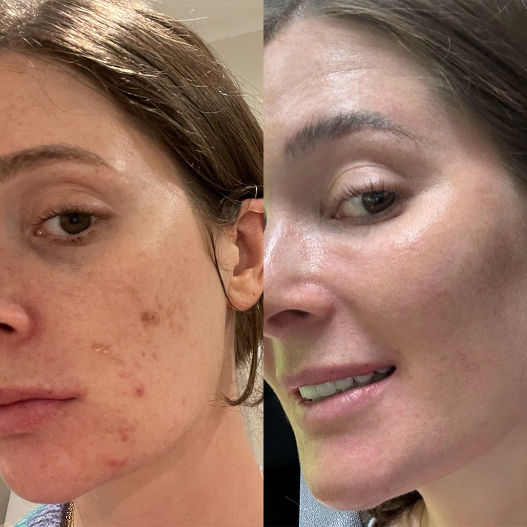 Ein Vorher- und Nachher Bild einer Kundin mit starken Unreinheiten.