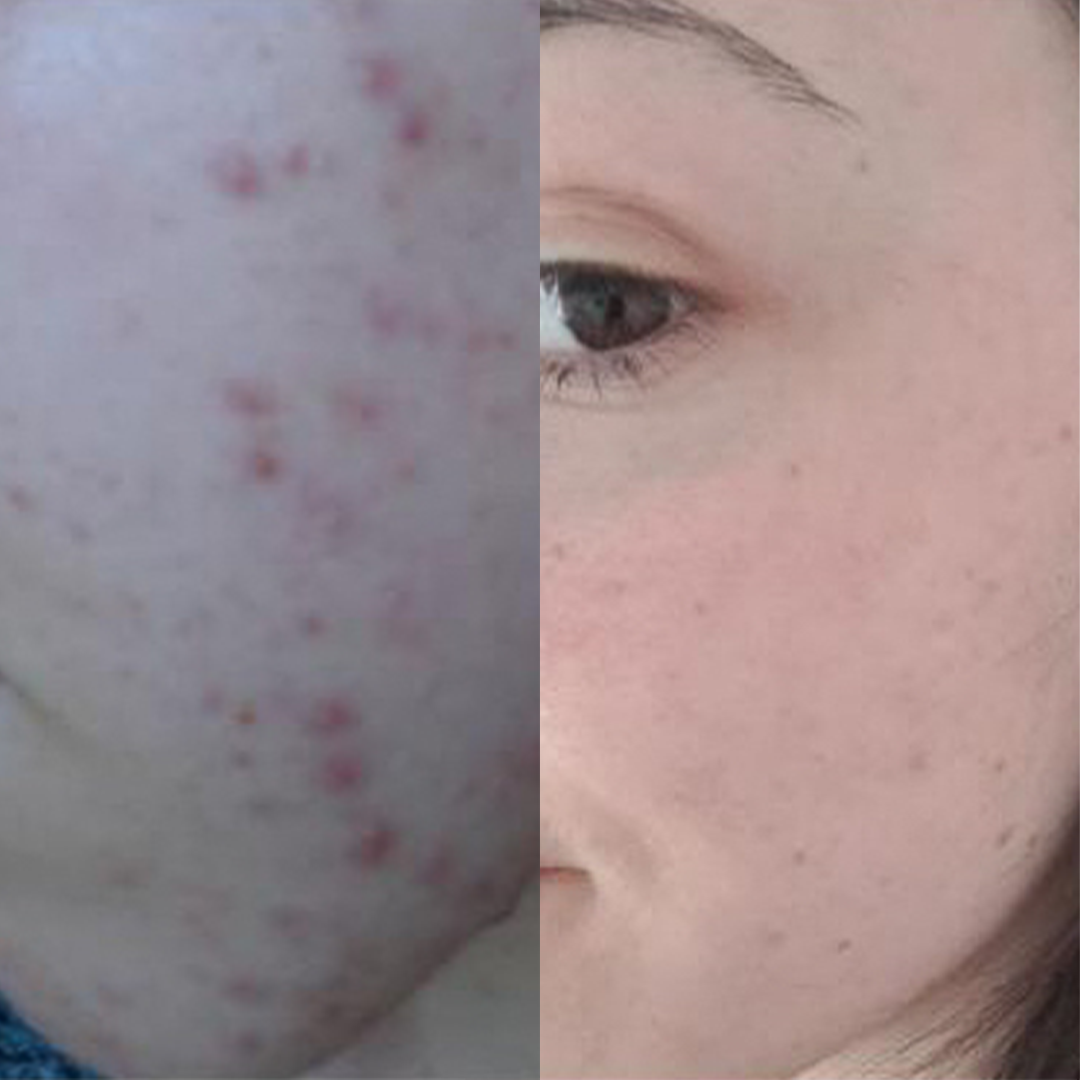 Ein Vorher- und Nachher Bild einer Kundin mit starken Unreinheiten.