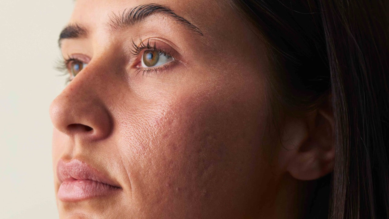 Was tun gegen Pickel im Gesicht? Deine Pflegeroutine mit nkm