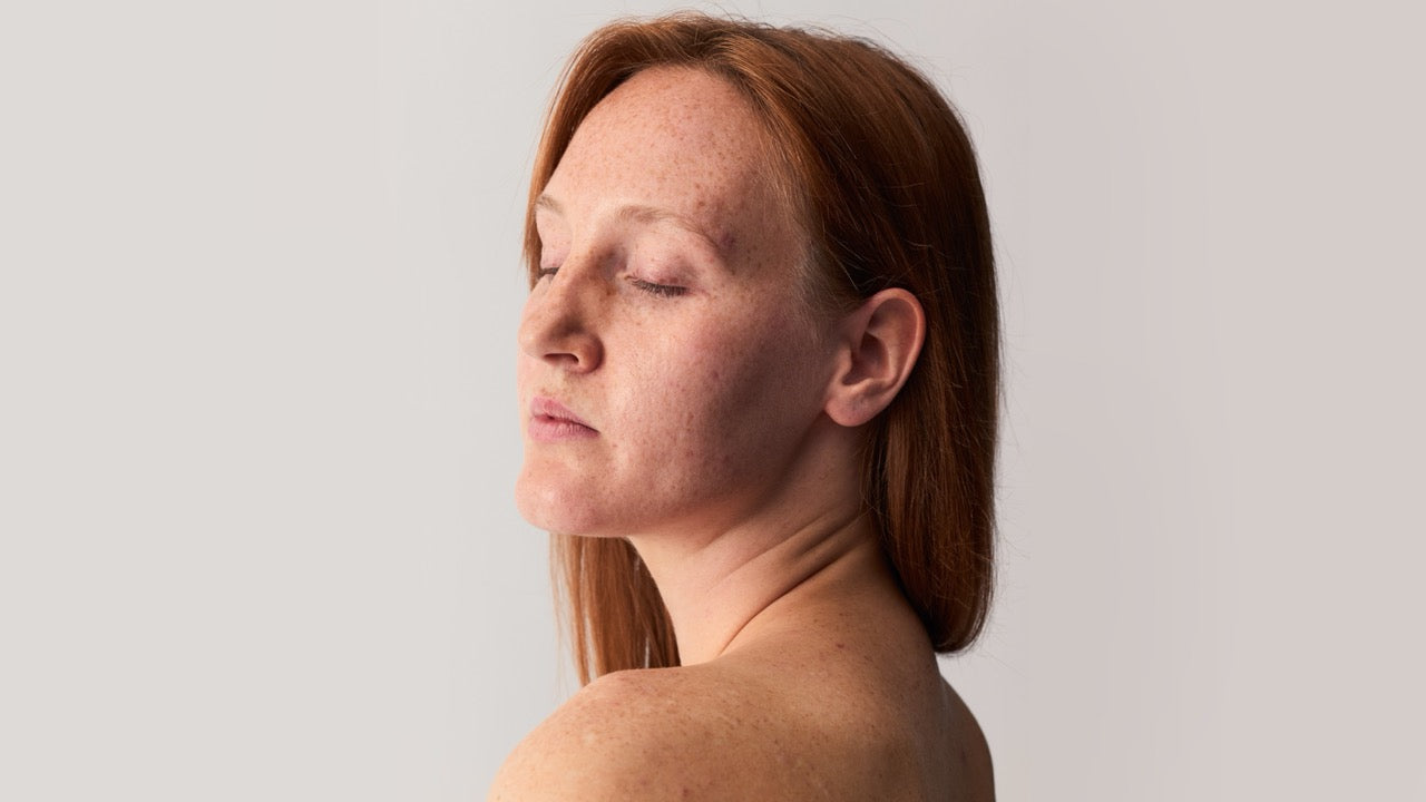 Was ist eine Periorale Dermatitis?