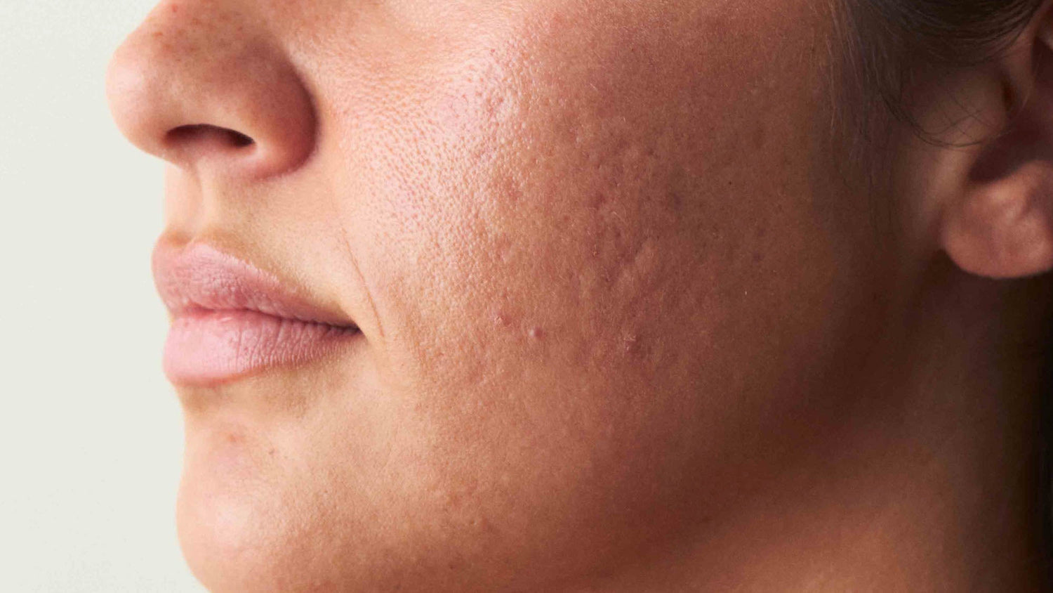 Hautpflege für unreine Haut ab 30