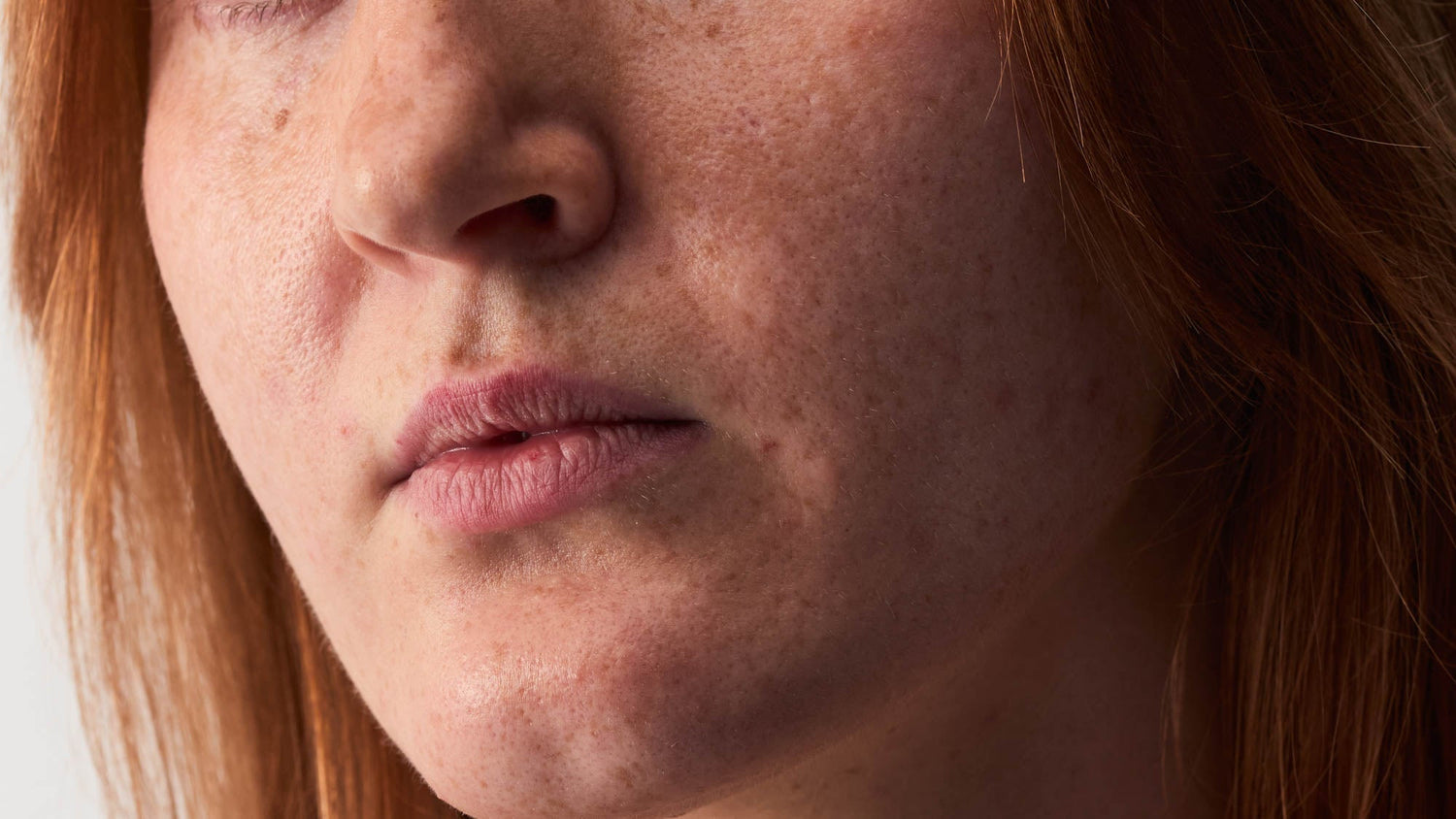 Rosazea & Periorale Dermatitis: Natürliche Pflege für sensible Haut