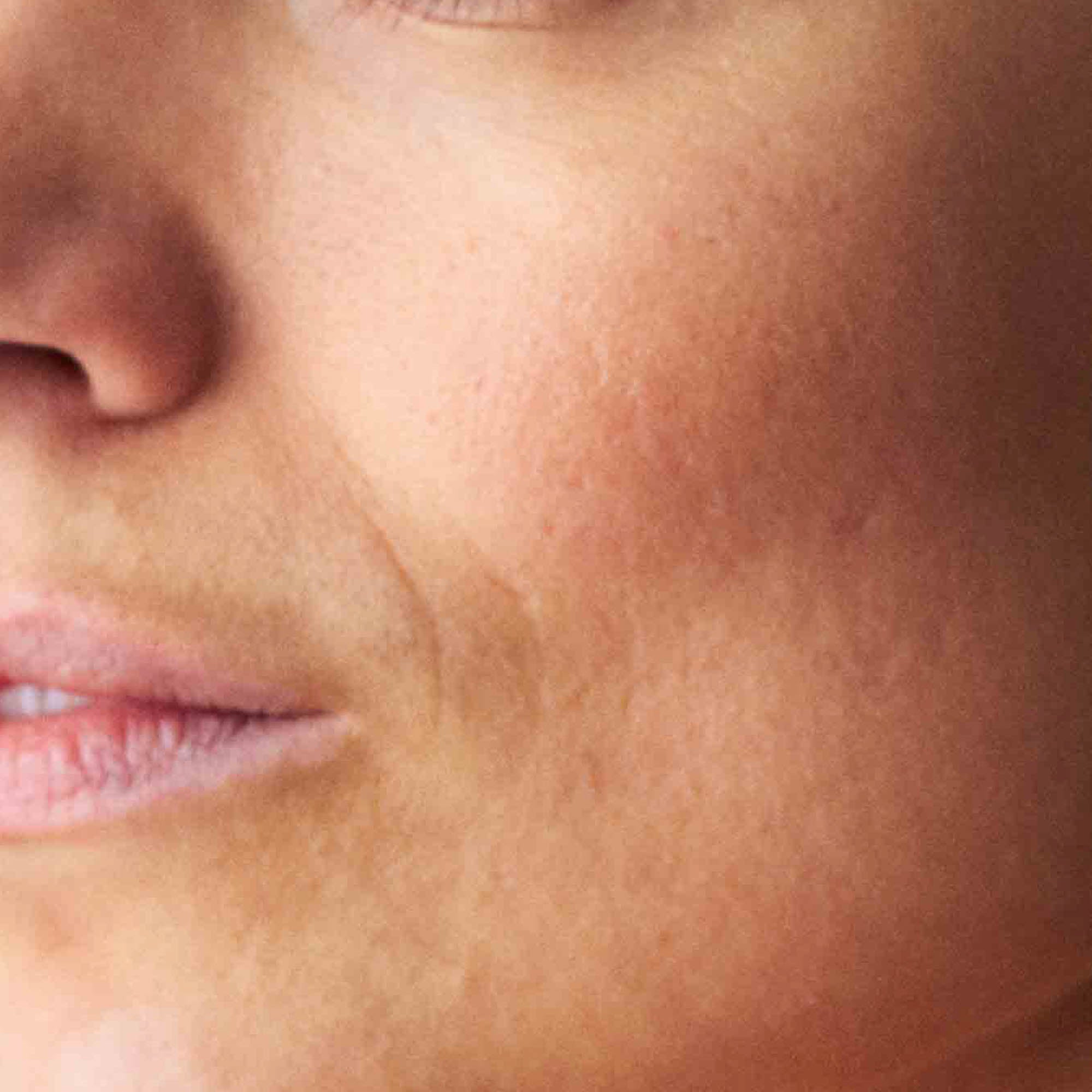 Nahaufnahme trockene Haut