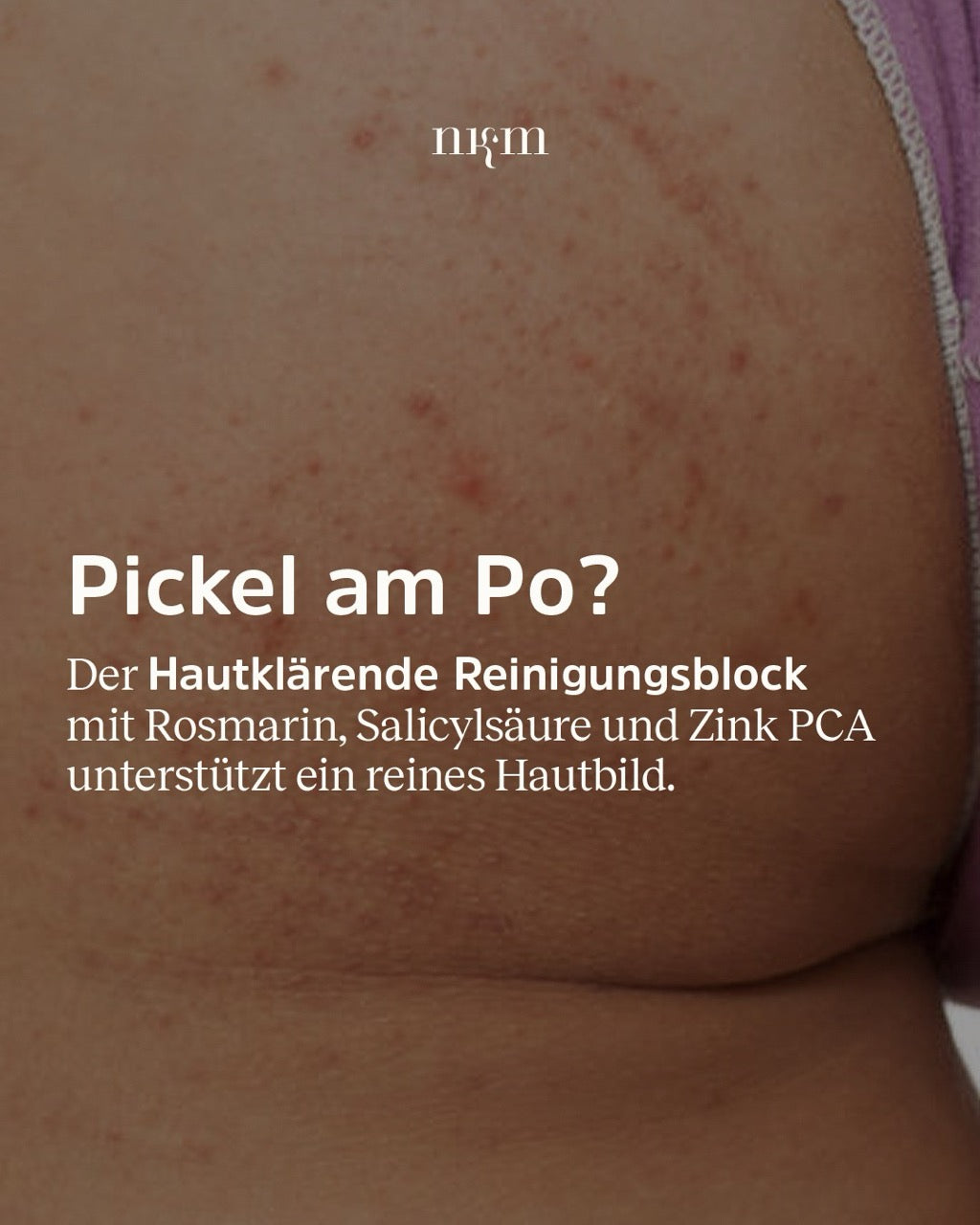 Pickel am Po?| nkm