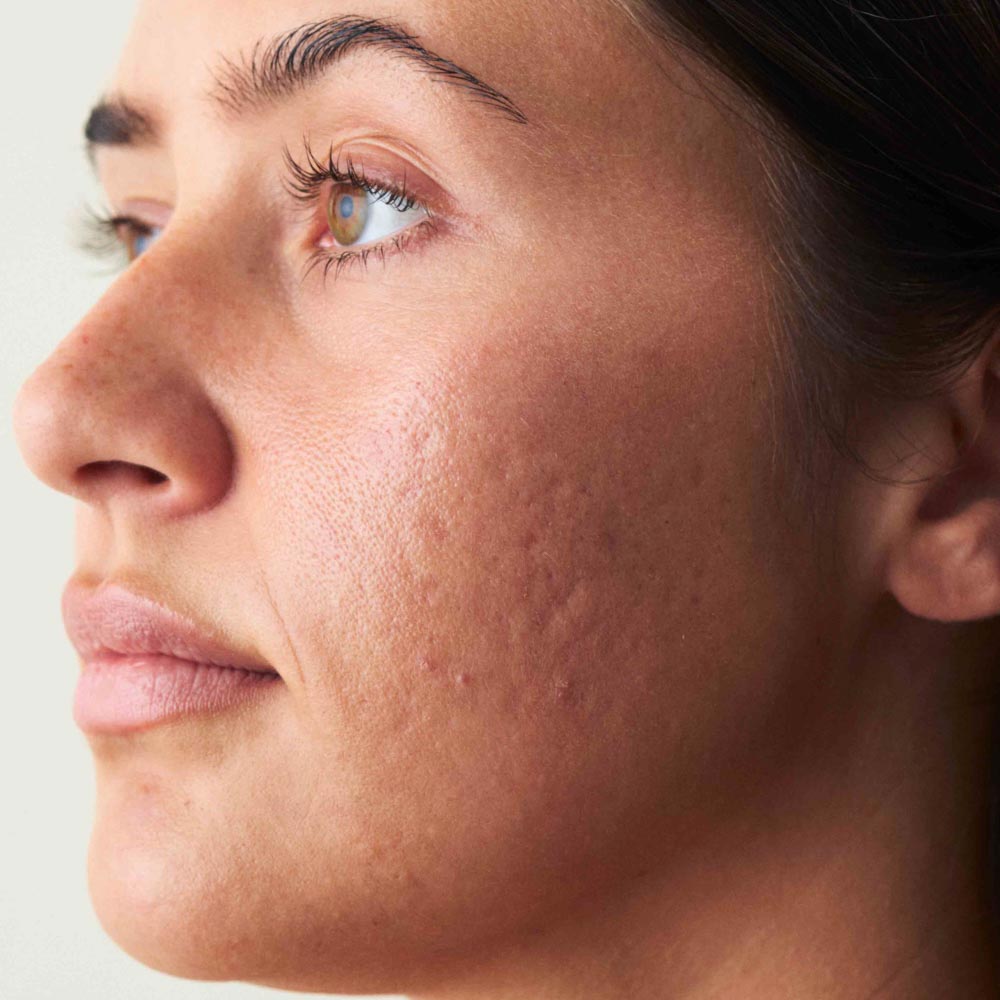 Gesicht Nahaufnahme von einer unreinen Haut