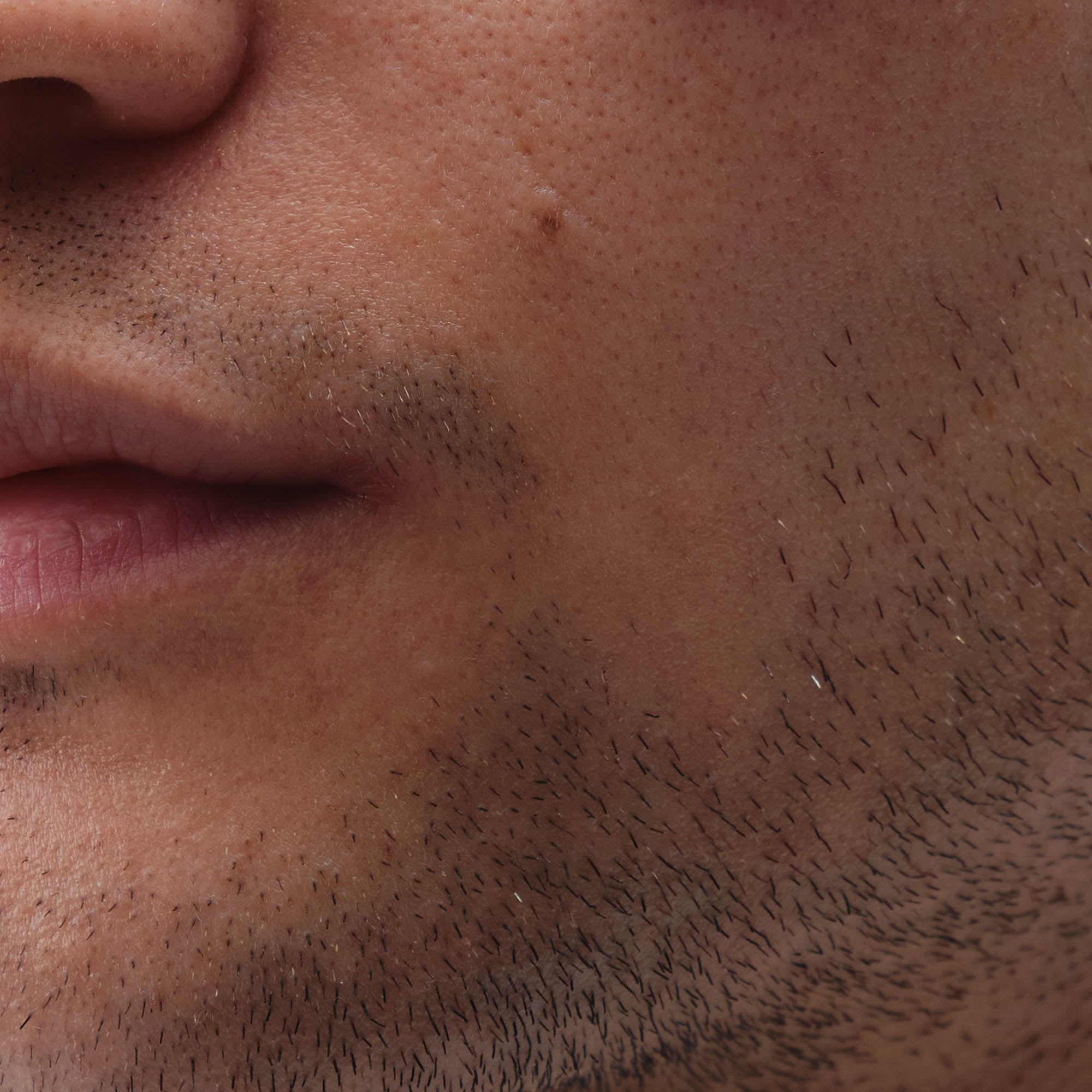 Nahaufnahme trockene Haut