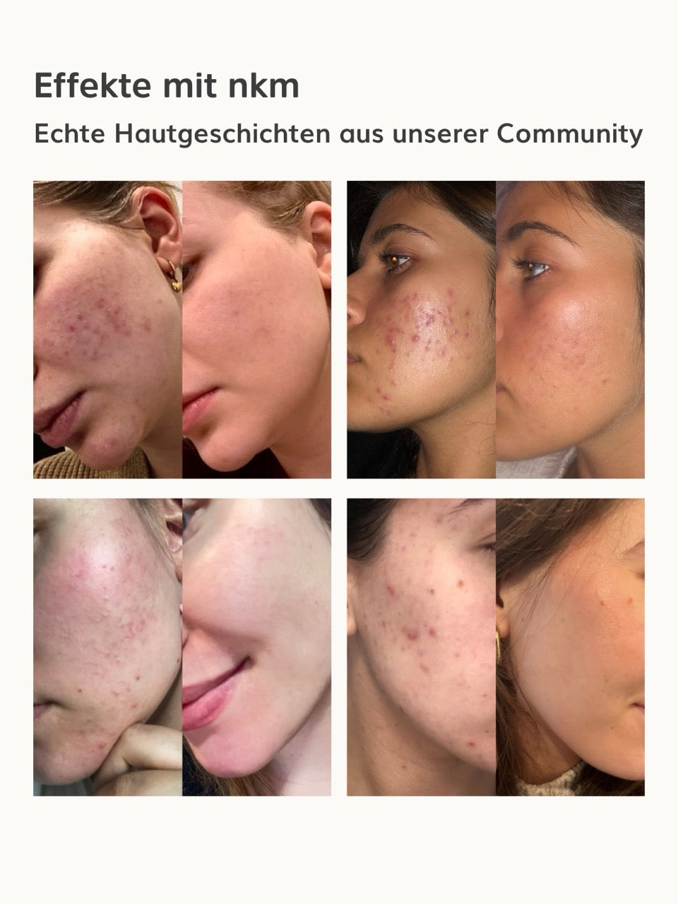 Vorher-nachher-Vergleich der Hautzustände von nkm Kund:innen.